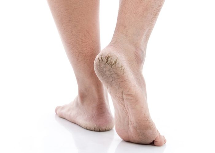 Mengalami Tumit Pecah, Coba Terapkan 7 Cara Mengatasinya Ini!