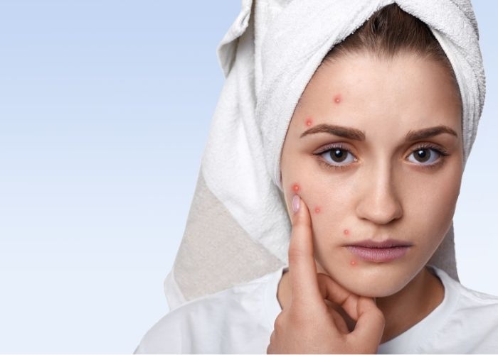 7 Penyebab Jerawat Sulit Hilang, Salah Satunya Karena Pola Makan Tidak Sehat