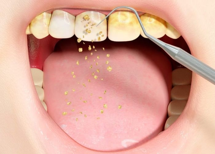 Info Tips: Perawatan Alami Rumahan untuk Mencegah dan Mengurangi Karang Gigi