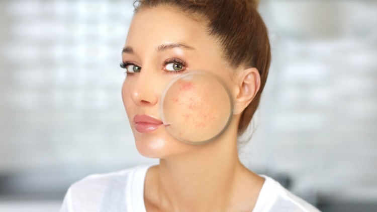 Berikut 4 Tips Mengatasi Jerawat Bernanah yang Sangat Mengganggu Penampilan