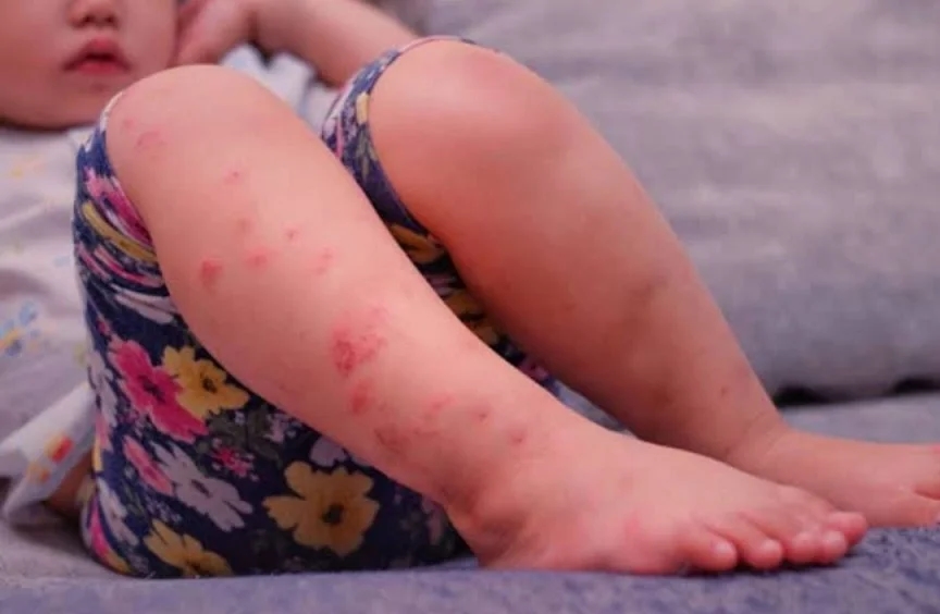 Terjadi Ruam pada Kulit, Benjolan Kecil-kecil di Telapak Tangan Kaki dan Mulut, Gejala Penyakit Apa? Waspada Gejala Flu Singapura